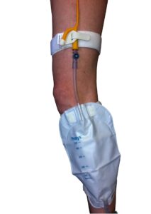 Image of a urinary catheter strapped to a leg