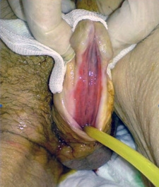 An image of a metal tear being examined