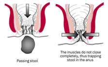 A pair of diagrams showing the anus passing stool, and the muscles failing to close, trapping stool