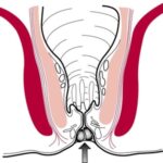A diagram of stool trapped in the anal opening