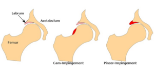 Diagram of 3 different hip impingements