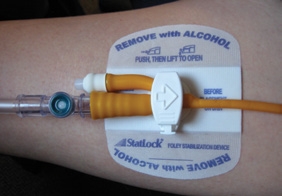 The Statlock Foley Stabilisation Device