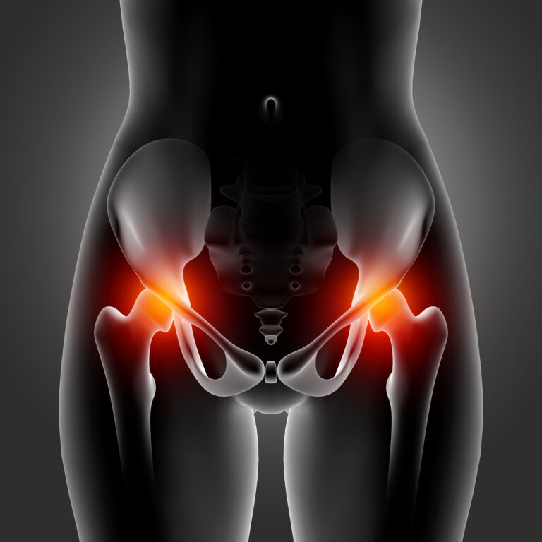 Osteoarthritis of the hip (OA hip)