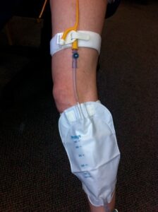 Caring for your indwelling urinary catheter