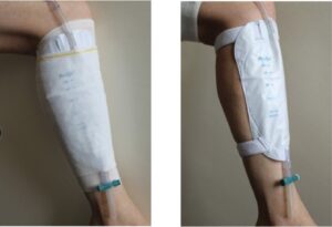 Securing and supporting your catheter and drainage bags 