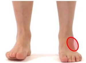 sprained ankle