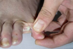 Athlete's foot