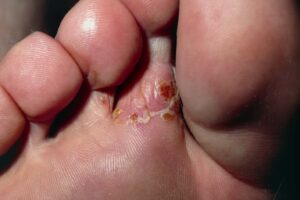 Athlete foot