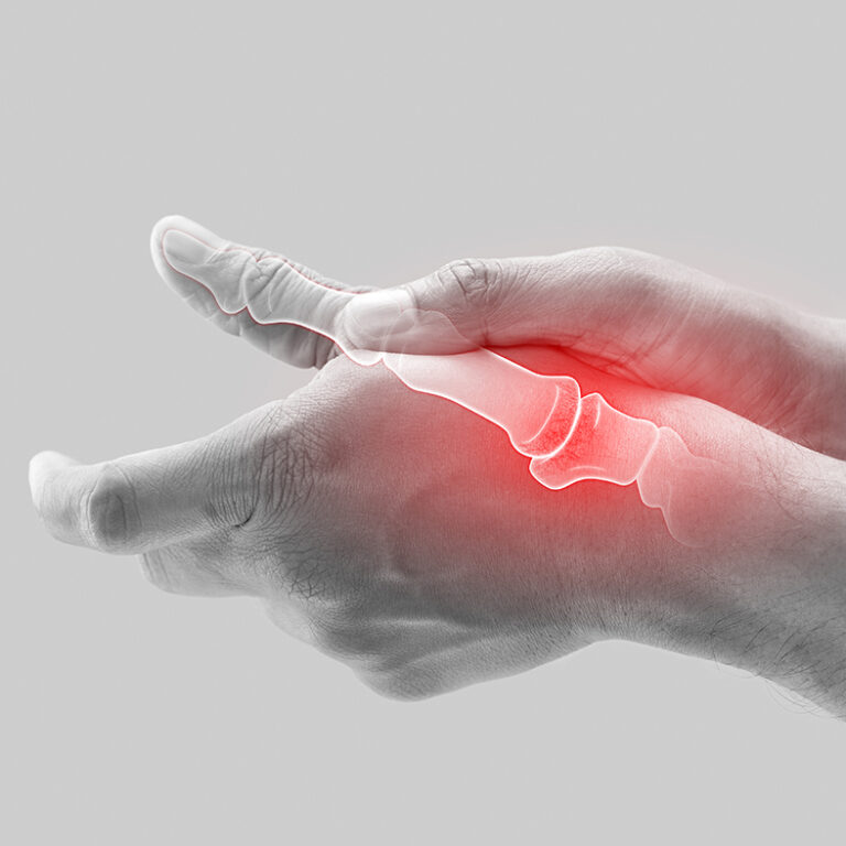 Basal thumb Osteoarthritis
