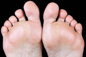 Calluses are larger patches of rough, thick skin