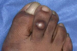 Corns and calluses can also be tender or painful.