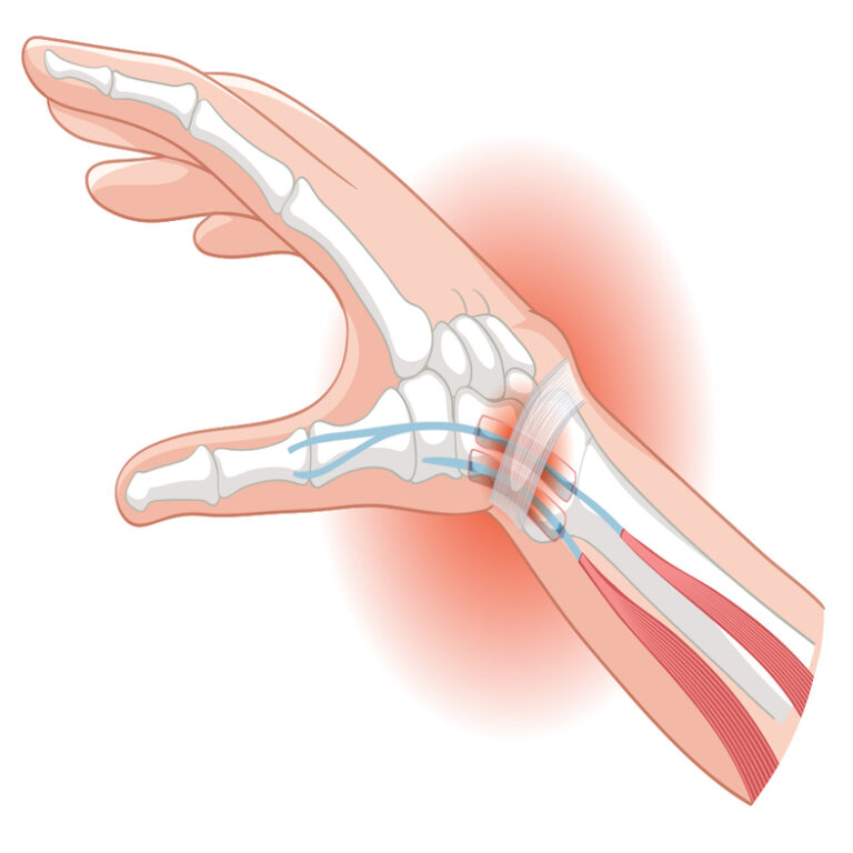 De Quervain's Tenosynovitis