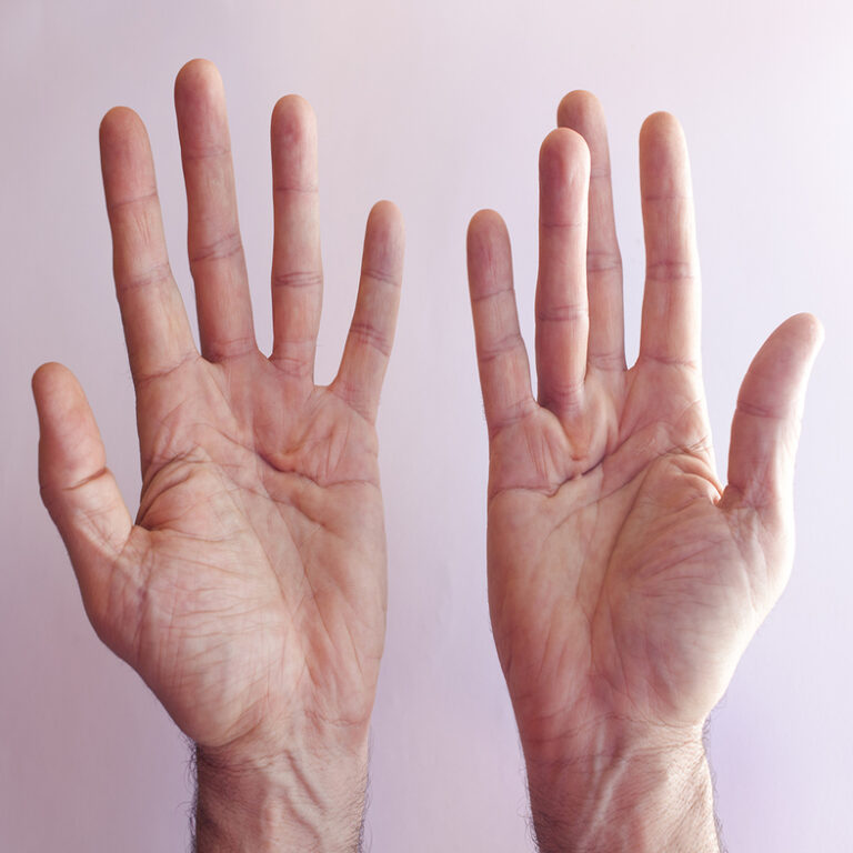 Dupuytren's Contracture