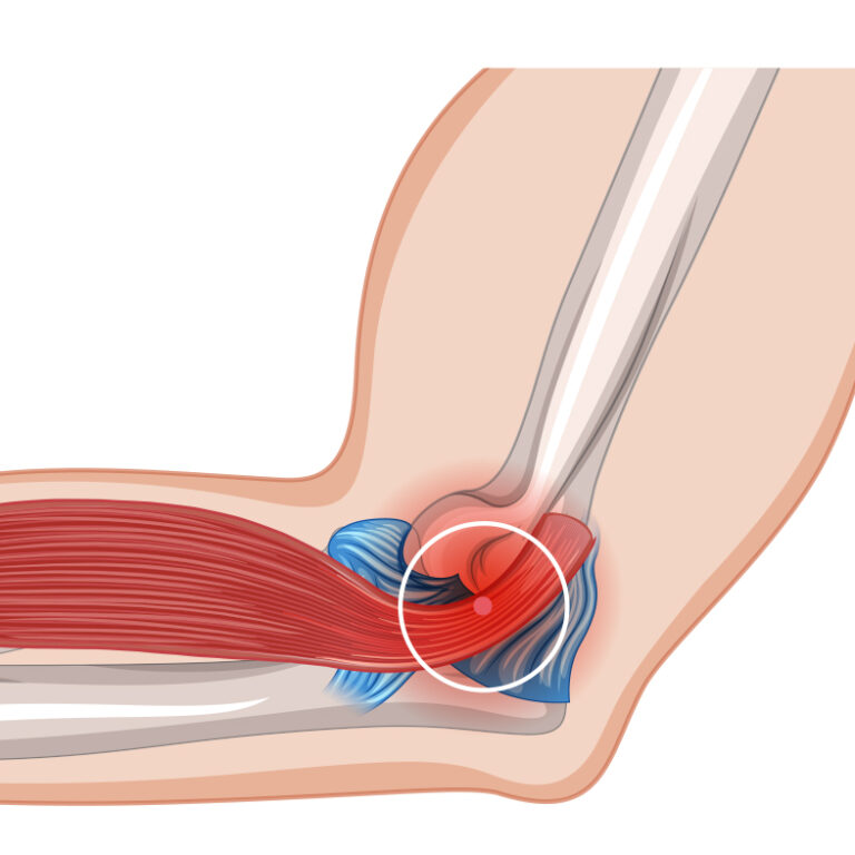 Golfer's Elbow