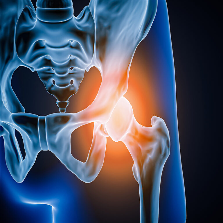 Osteoarthritis of the hip (OA hip)