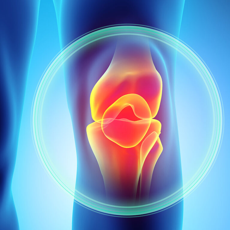 Osteoarthritis of the knee
