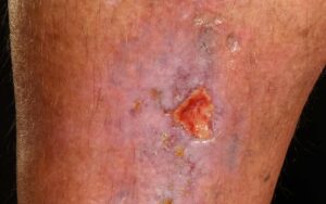 legs venous ulcer