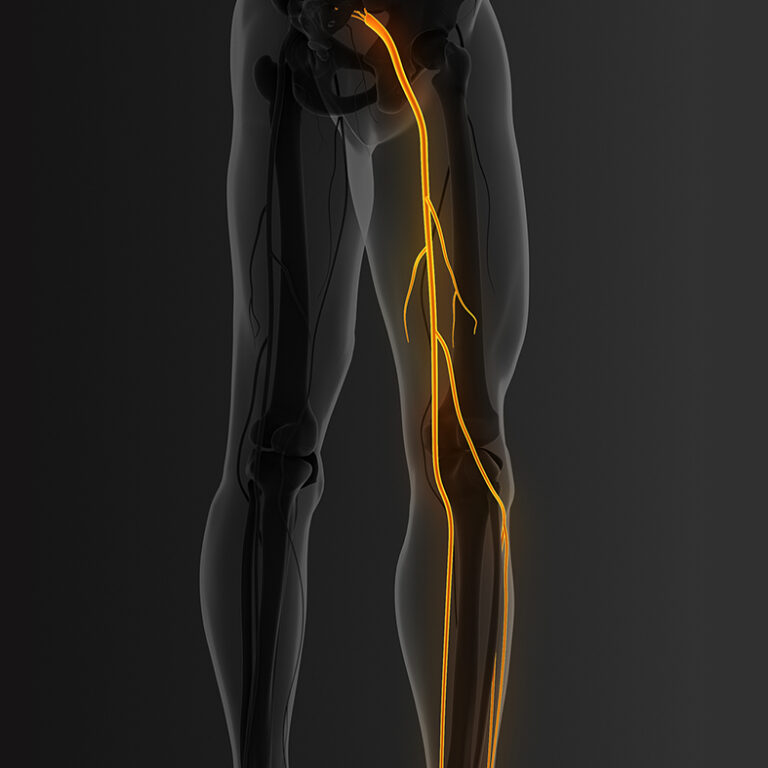 Low back pain with leg pain and sciatica
