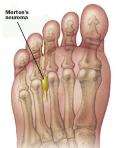 neuroma