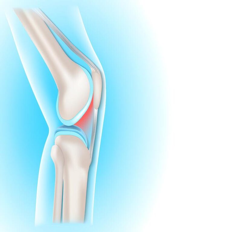 Patella tendonopathy