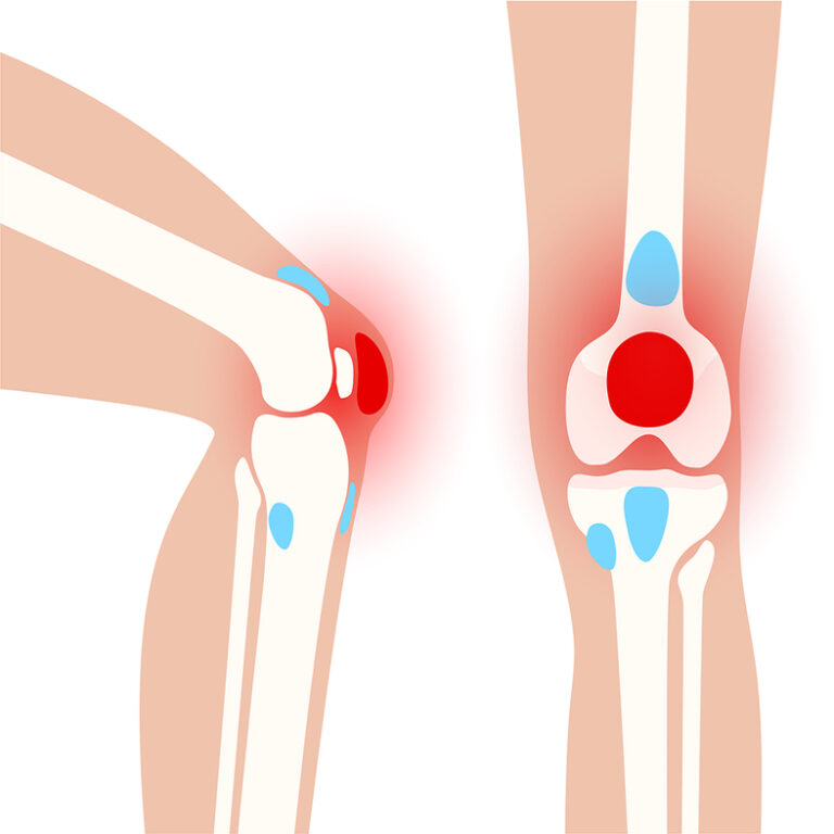 Pre-patella bursitis