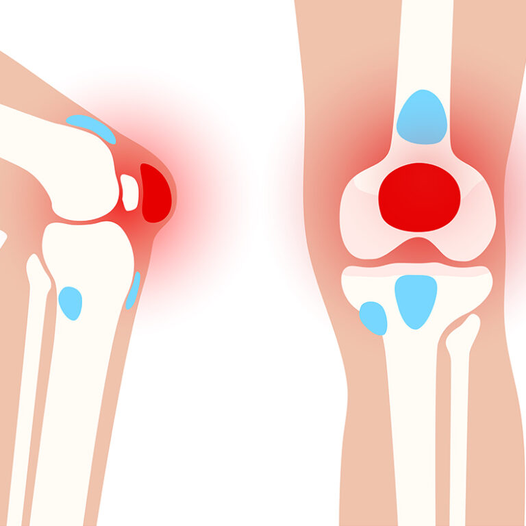 Pre-patella bursitis
