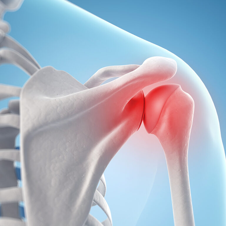 Osteoarthritis (OA) of the shoulder