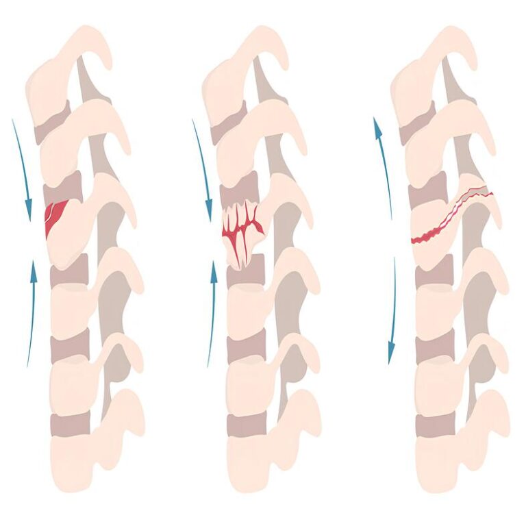 Spinal fractures