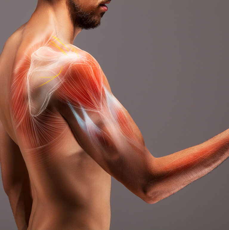 Sub-acromial shoulder pain
