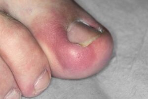 Symptoms of an ingrown toenail