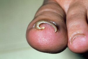 Symptoms of an ingrown toenail