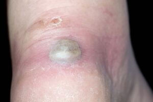 Symptoms of blisters
