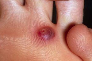 Symptoms of blisters
