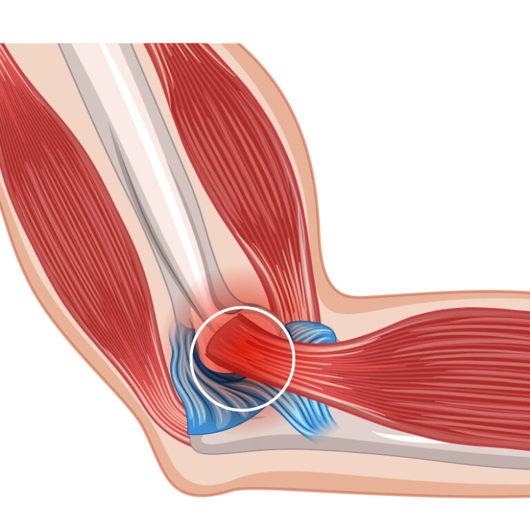 Tennis Elbow