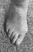 toe and forefoot pain