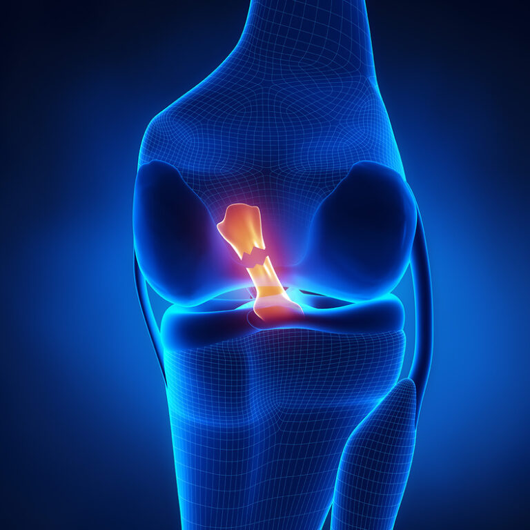 Traumatic knee injuries