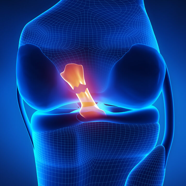 Traumatic knee injuries