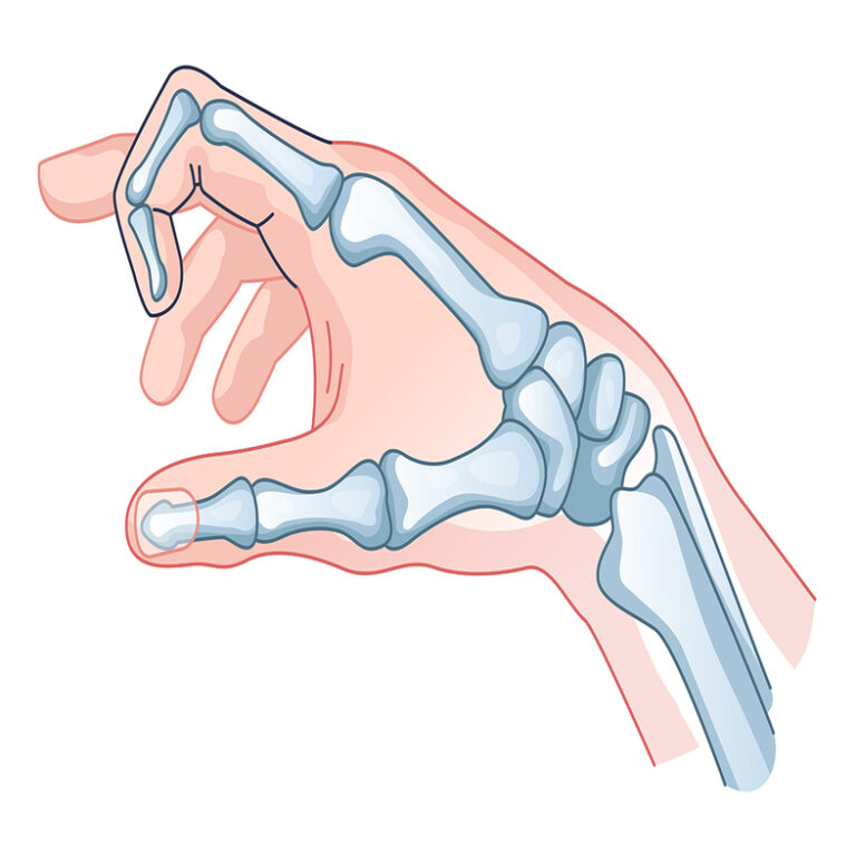 Trigger finger