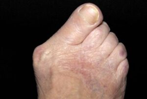 bunion
