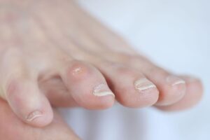 corns and small lumps of hard skin