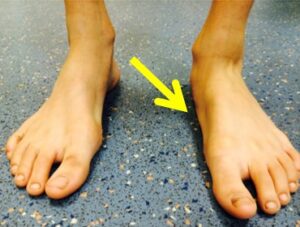 flat foot