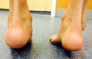 flat foot