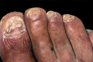 fungal nail infection