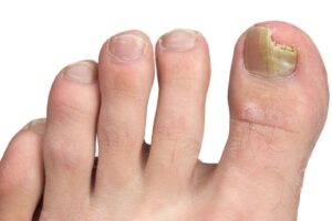 fungal nail infection