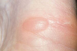Blisters are small pockets of clear fluid under a layer of skin.