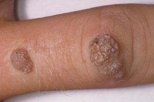 Warts feel firm and rough
