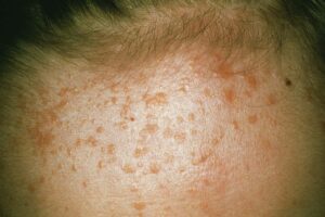Some warts are round, flat and can be yellow