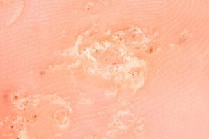 Clusters of warts spread over an area of skin