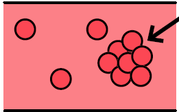 blood clot