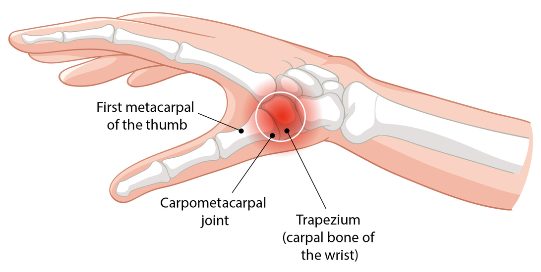First metacarpal of the thumb, highlighting CMC joint arthritis with visible swelling and joint deformity.